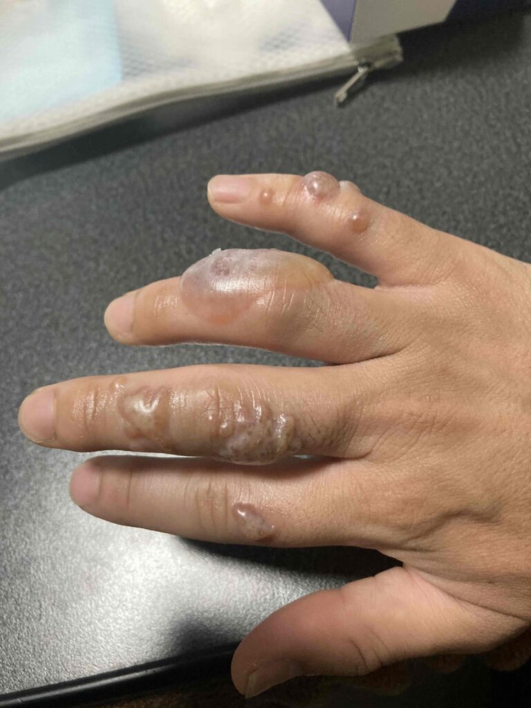 イラモ被害画像